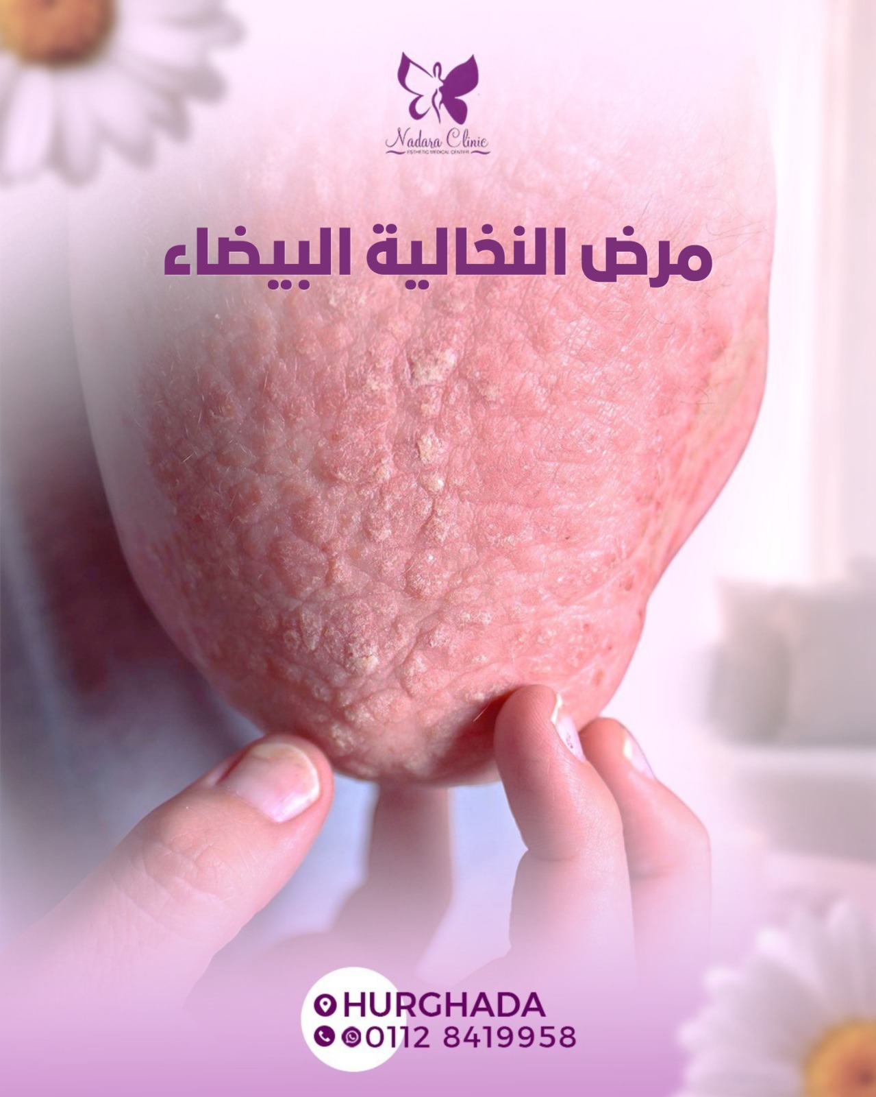 مرض النخالة البيضاء في الغردقة